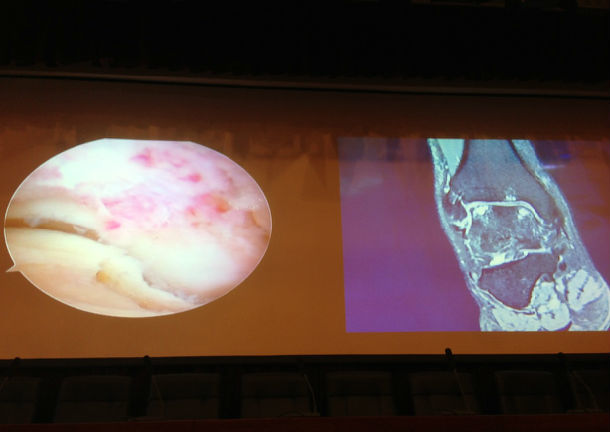 高绪仁北医三院运动医学科观摩胡跃林踝肿痛踝关节镜微创手.