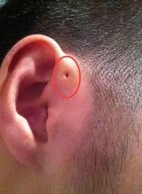 耳前小洞是瘘管容易感染要重视 - 微医(挂号网