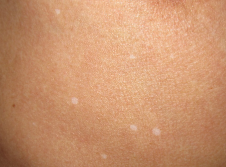 "白斑"不等于"白癜风" _张江林医生文章_深圳市人民医院-微医