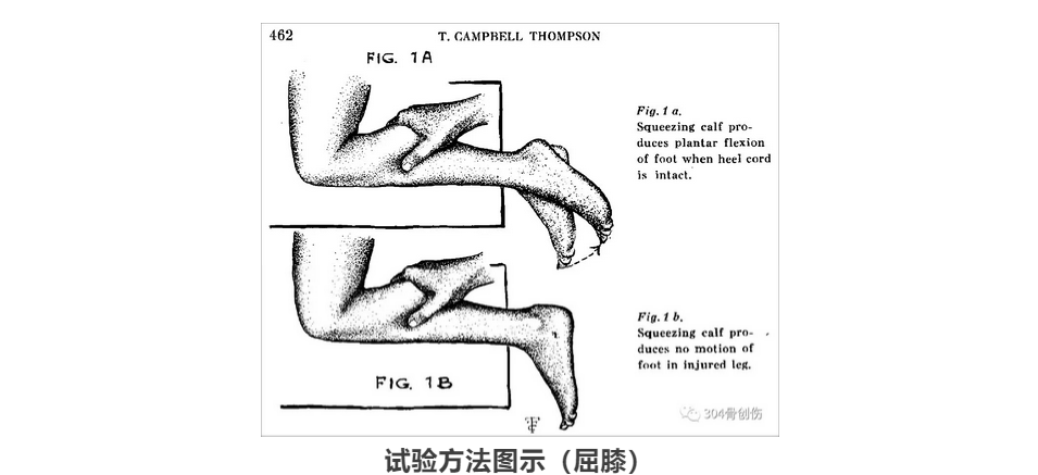 肌腱跟腱thompson试验发现之谜