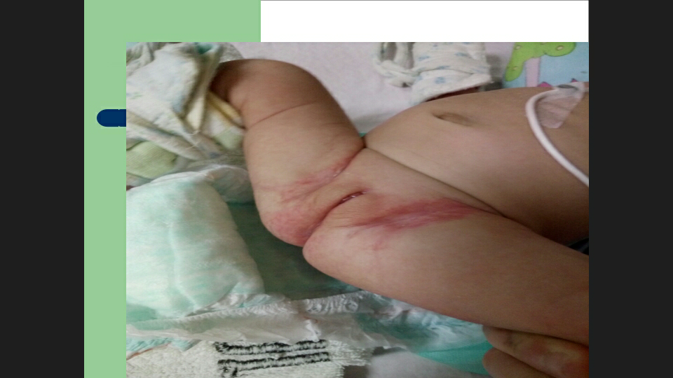 宝宝红屁股该如何处理?