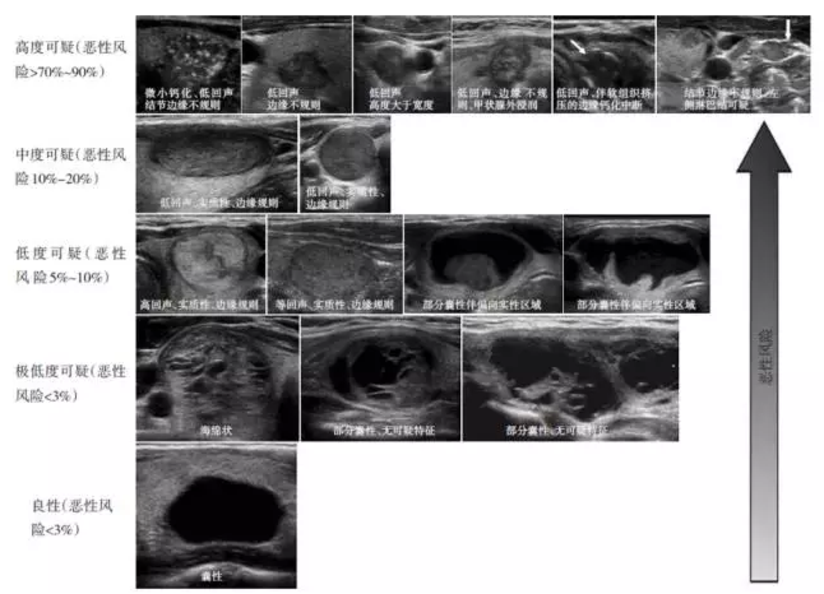 甲状腺结节诊断和治疗临床实践医学指南 解读 健康号 微医