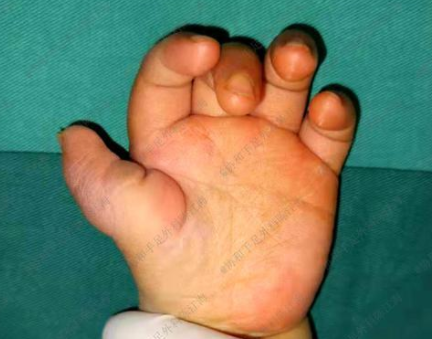 新生儿拇指无掌骨漂浮拇可以保住术后外观较为理想功能也不错