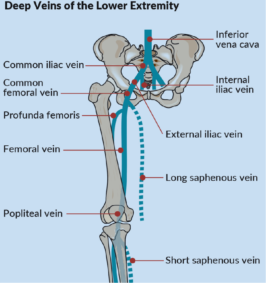 米国sir2023:急性髂股深静脉血栓形成血管内治疗的立场声明12条建议