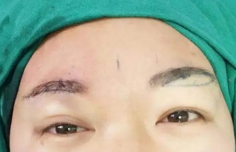 提眉手术的5个细节,解决你心中的困惑! - 微医(挂号网)