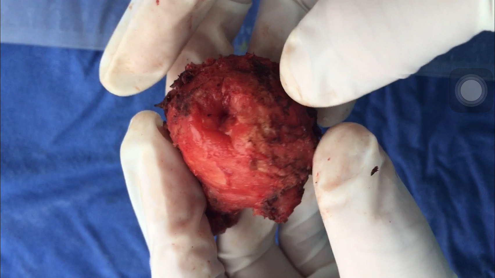 腹腔镜微创根治术治疗高危局部进展性前列腺癌