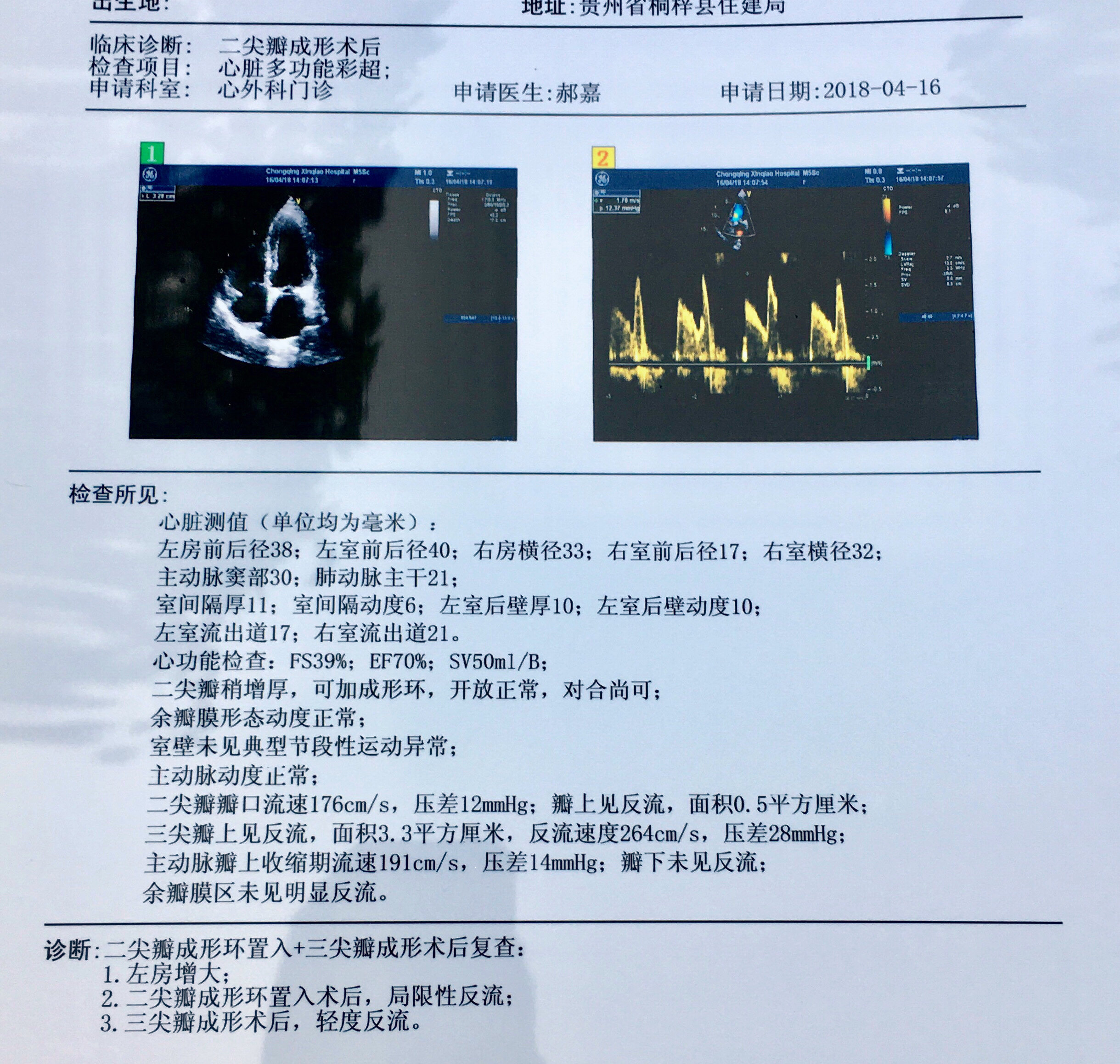 二尖瓣关闭不全是直接换瓣还是先考虑成形修复