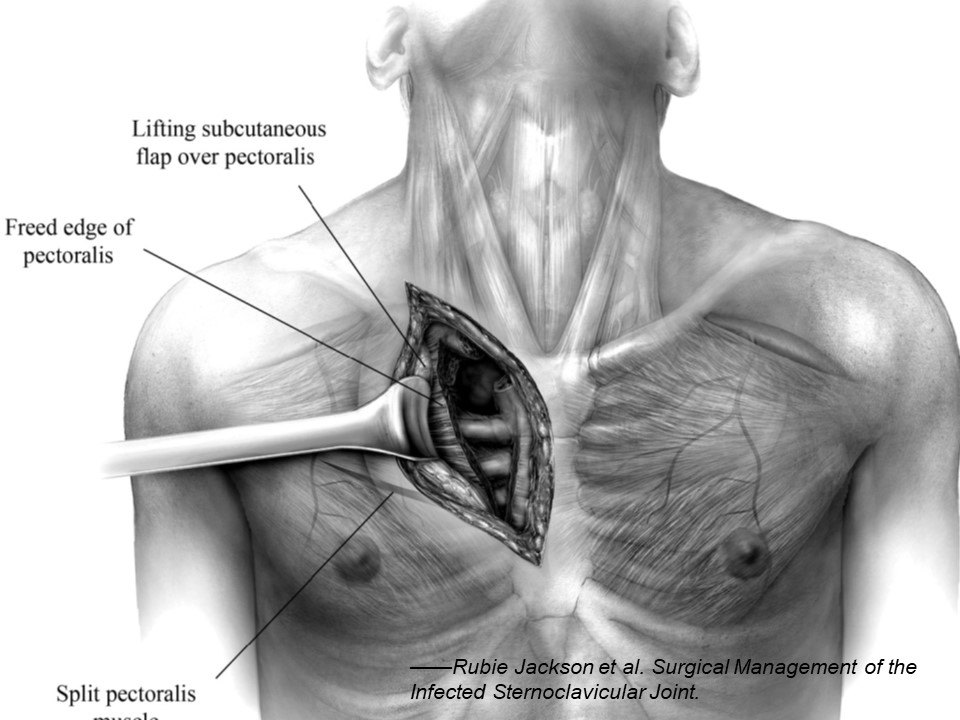 胸锁关节感染的外科治疗
