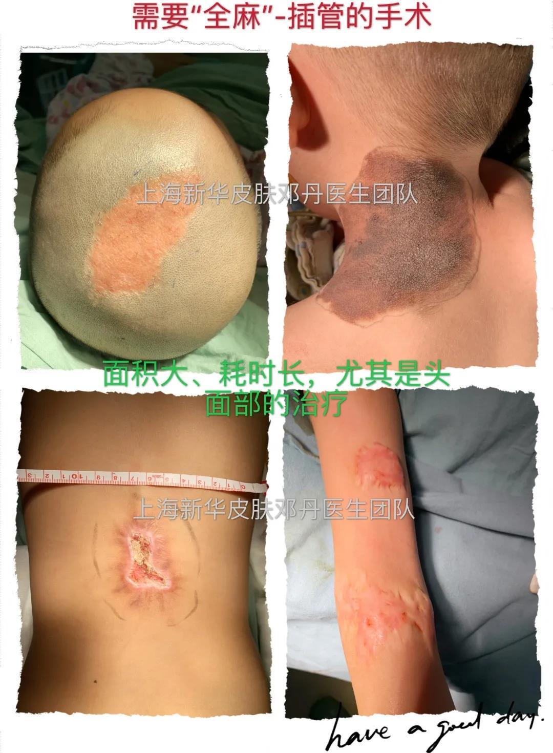 儿童手术麻醉之静脉镇静局麻