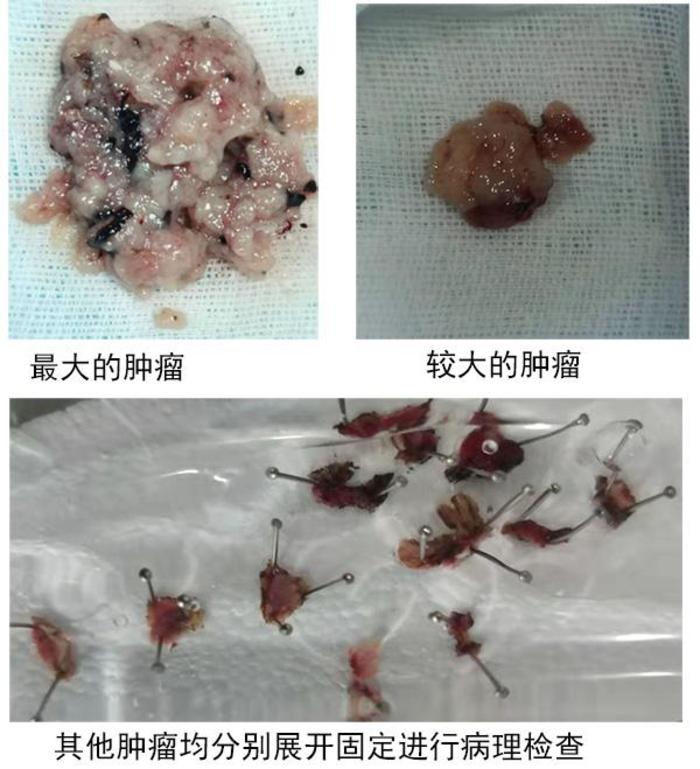 膀胱保卫战(一)——如果膀胱里长了很多肿瘤,肿瘤很大还能保膀胱吗?