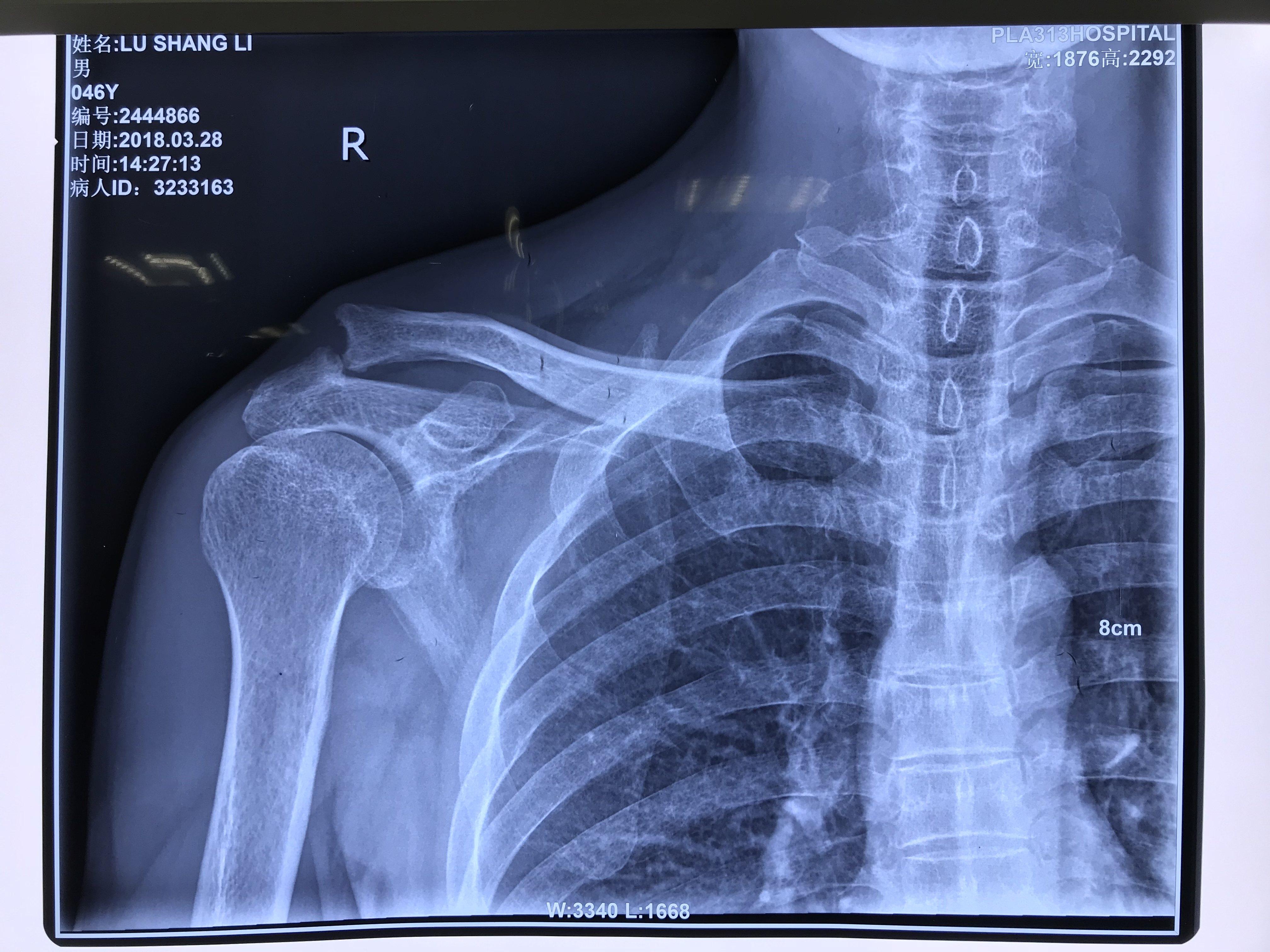 肩锁关节脱位Ⅲ型喙锁韧带重建手术