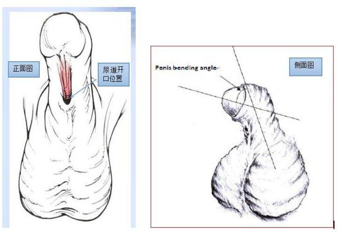 怎样拍摄照片适合尿道下裂网络咨询