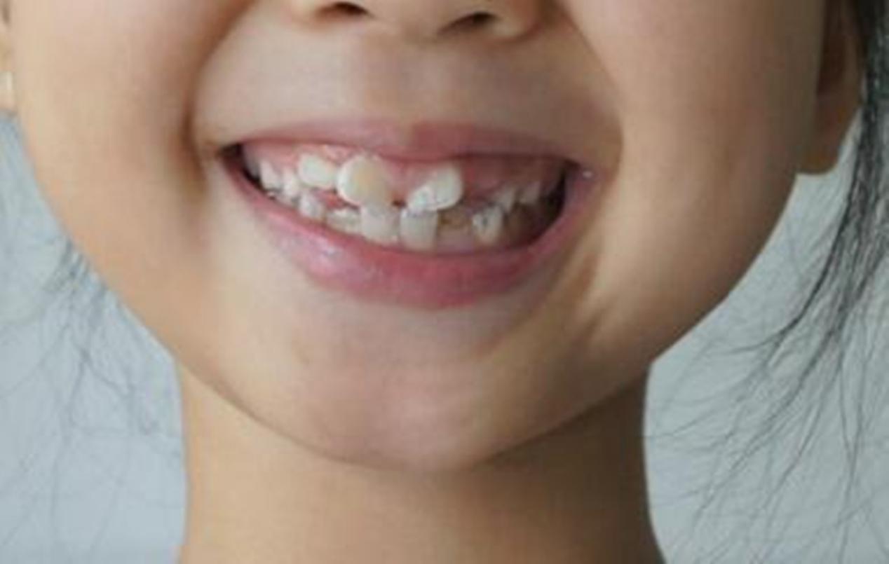 宝宝换牙后牙齿又大又黄,是怎么回事?-微医(挂号网)