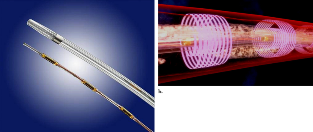 肺栓塞?导管溶栓是最适合的治疗