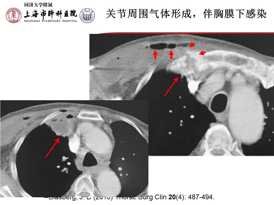 胸锁关节感染的外科治疗