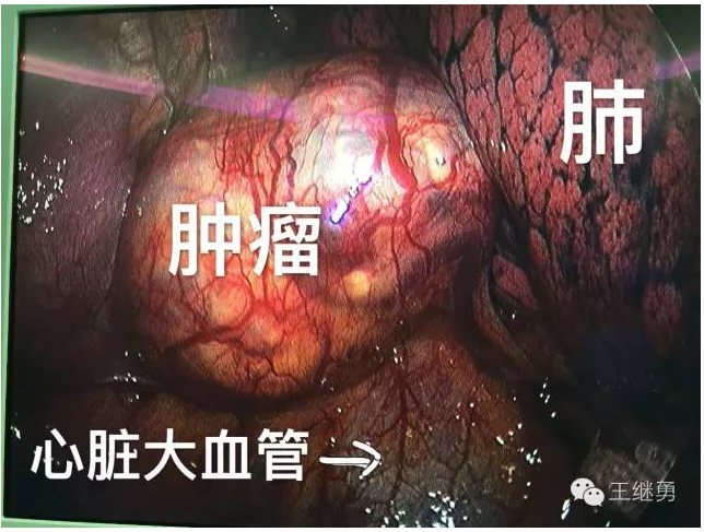 胸腺瘤,纵隔肿瘤怎么办? - 微医(挂号网)