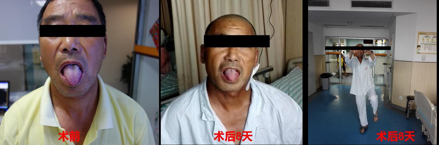典型病例,患者60多岁,因"反复声嘶2年,吞咽困难饮水呛咳2月,伸舌偏斜"
