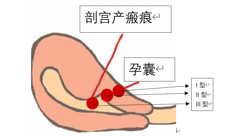 掉进坑里的受精卵异位妊娠之切口妊娠