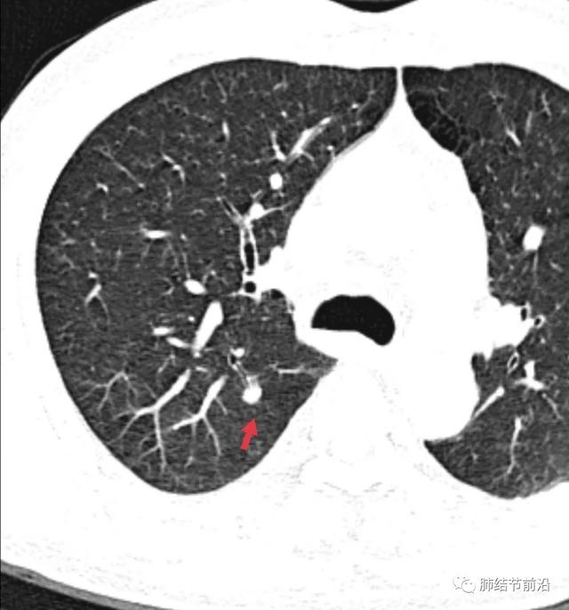 肺结节读片(5):具有决定意义的CT值 - 微医（挂号网）