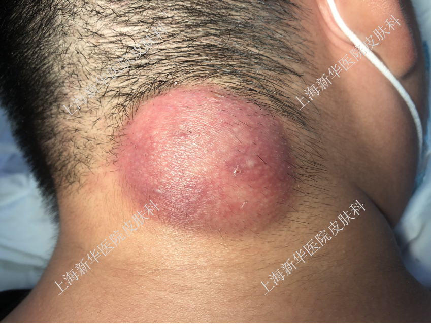 "粉瘤"是什么?该怎么治?总能挤出白色牙膏样东西.