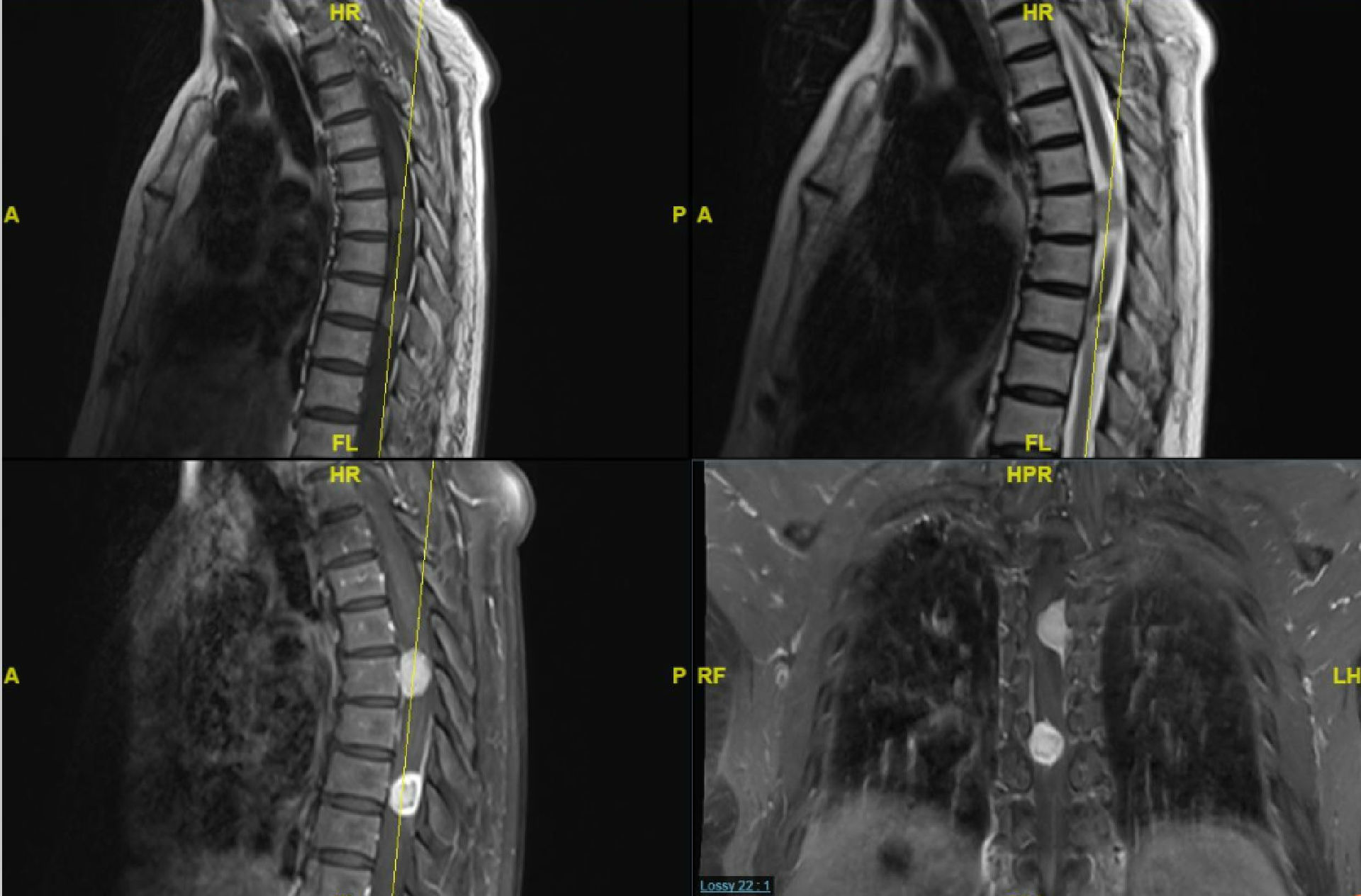 一个很有意思的胸椎管内肿瘤病例t6脊膜瘤t8神经鞘瘤 