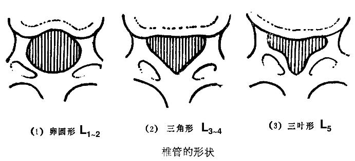 1995年sckiwainger首先提出骨性侧隐窝概念以来,腰椎侧隐窝狭窄症逐渐