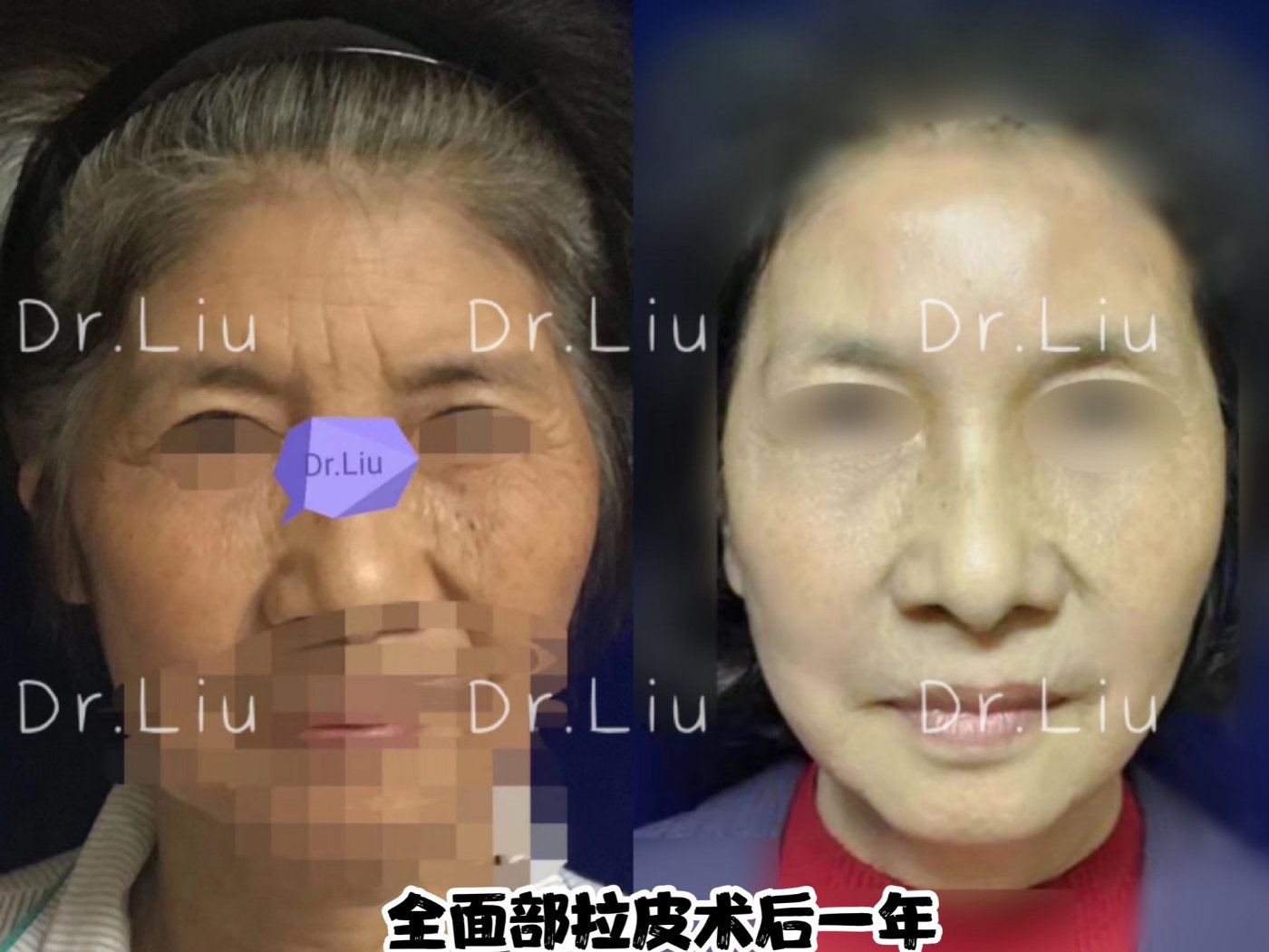 上海吴佳君医生做面部拉皮提升怎么样？