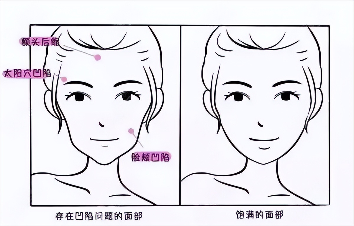 面部凹陷填充是否可以选择膨体材料