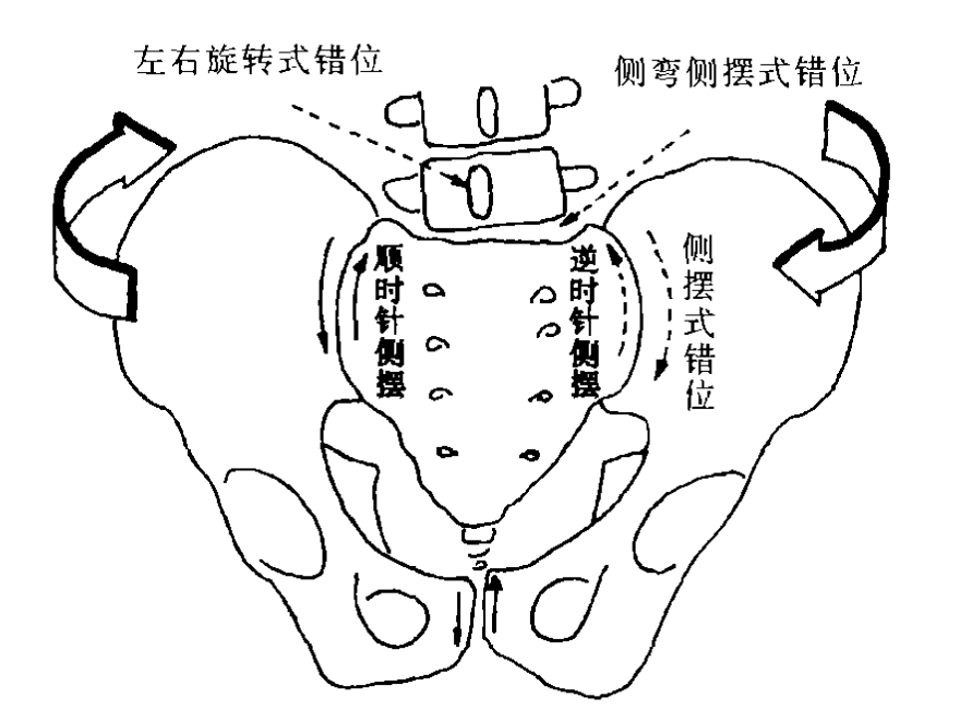 骨盆旋移到底是什么病