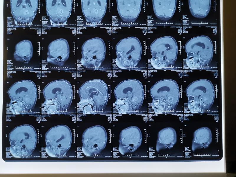 贺晓生教授谈儿童脑瘤:儿童四脑室室管膜瘤手术 - 微医(挂号网)