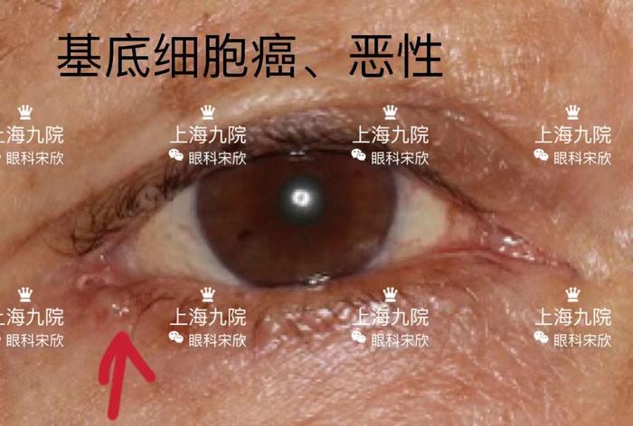 眼皮上奇奇怪怪的疙瘩都是什么常见眼睑肿瘤图片良恶性