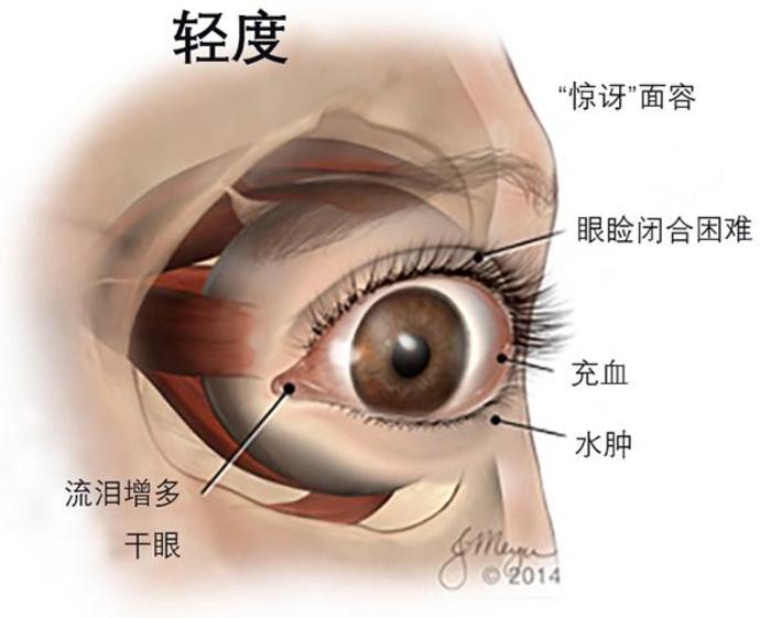 甲亢突眼,如何进行自我管理? - 微医(挂号网)