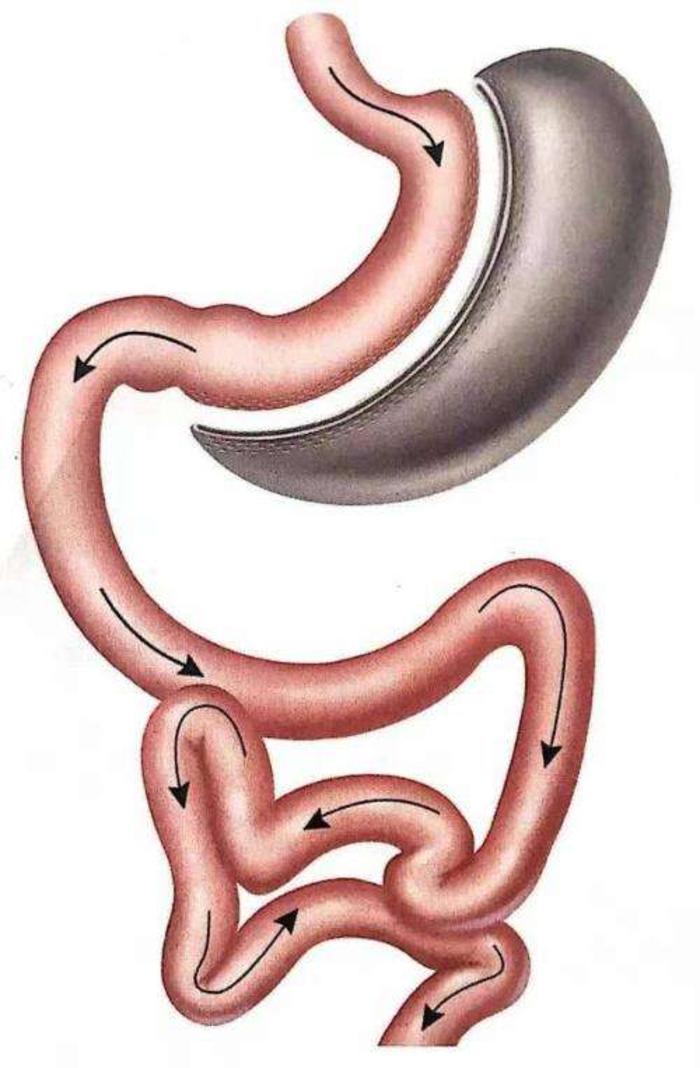 目前减重代谢外科手术有哪几种呢