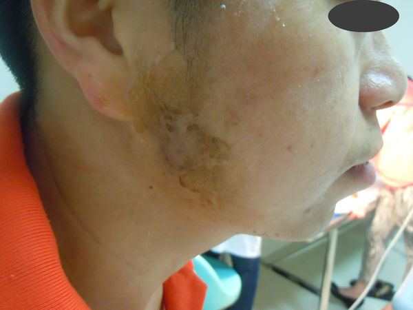 慢性腮腺炎转化为腮腺脓肿有图片