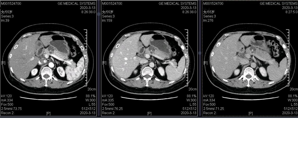 胰腺囊腺瘤是什么样子的?如何判断良恶性?该不该手术?