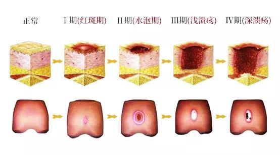 比如皮下組織會失養壞死,接著皮膚開始破潰,繼而潰瘍口徑擴大,深度