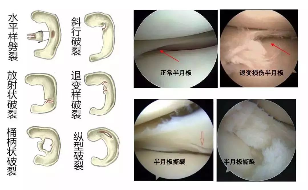 半月板损伤什么情况下需手术