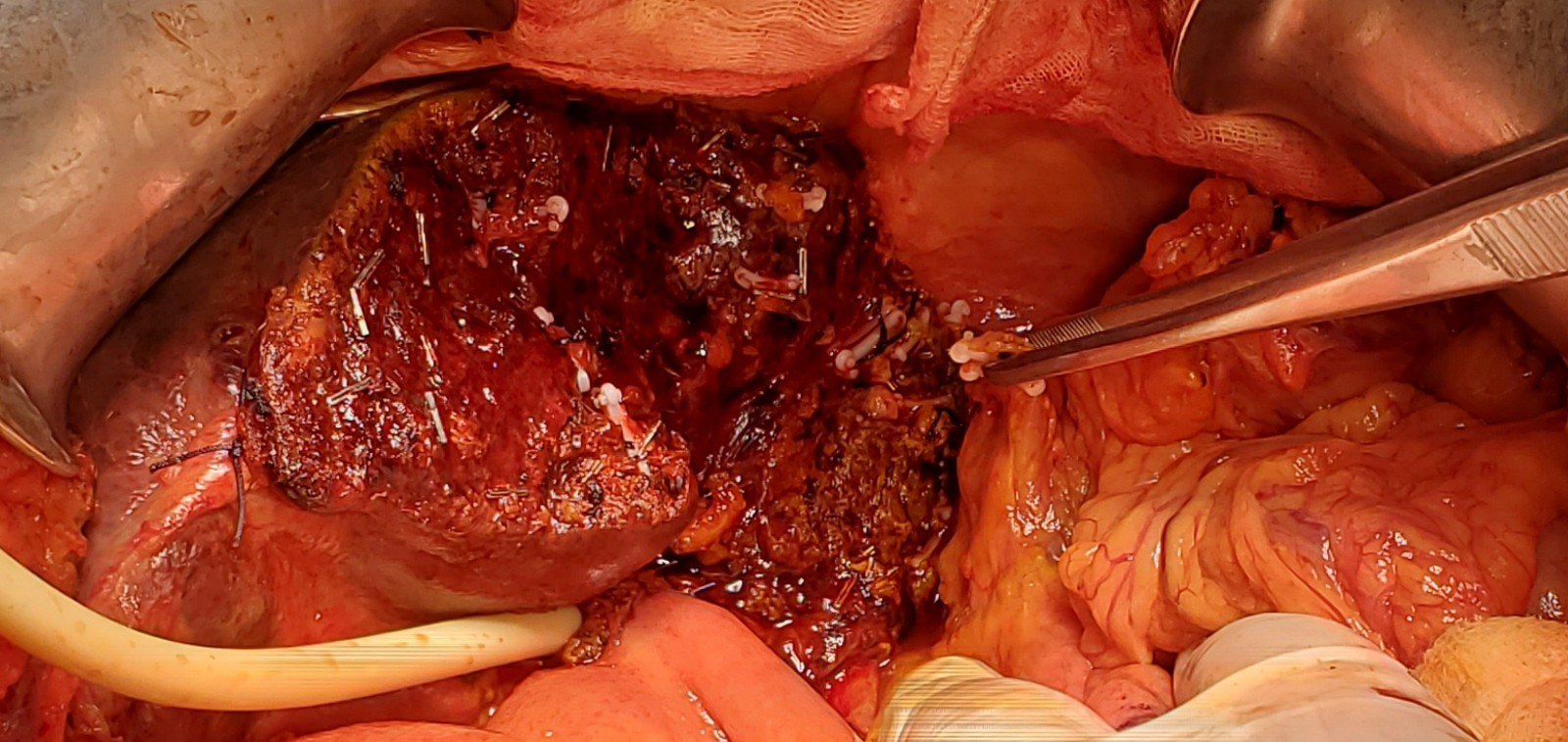 老年患者诊断胆总管癌合并肝内胆管癌是否能一次手术解决两个癌