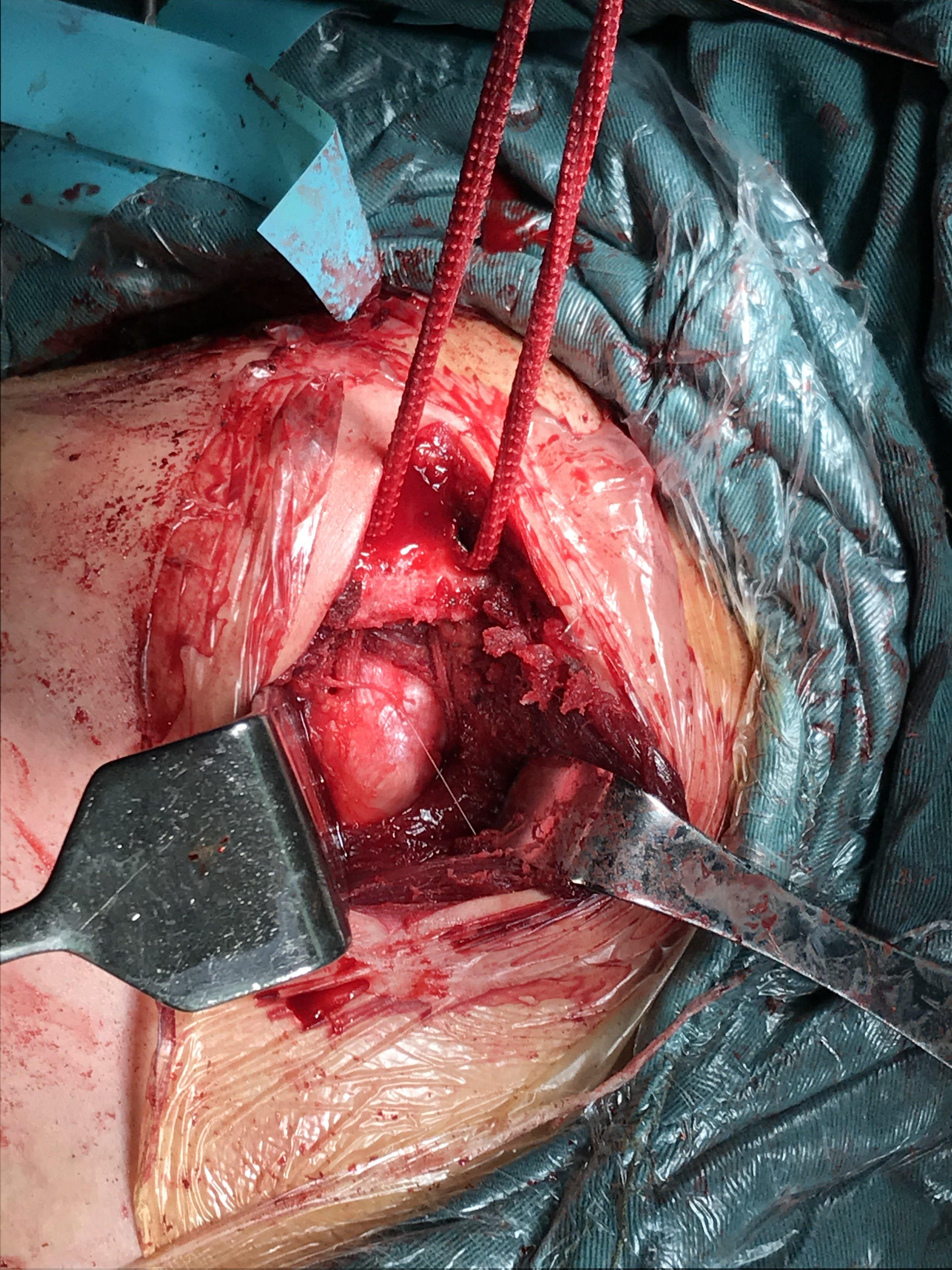 肩锁关节脱位Ⅲ型喙锁韧带重建手术