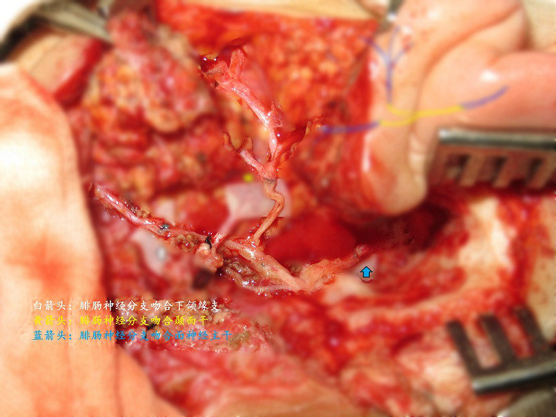 面神经肿瘤手术治疗附病例照片