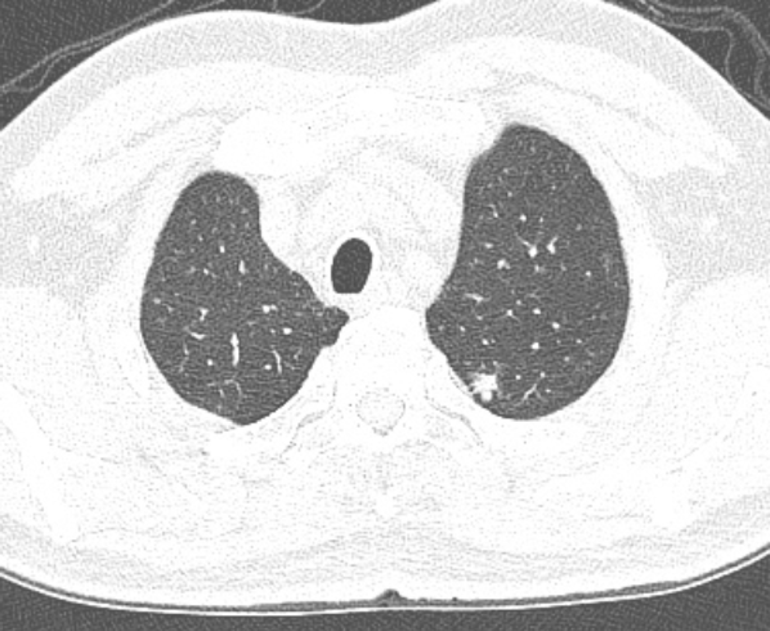 淋巴结比较大(肺部感染,吸烟,空气质量差等原因),由于ct层面越来越薄