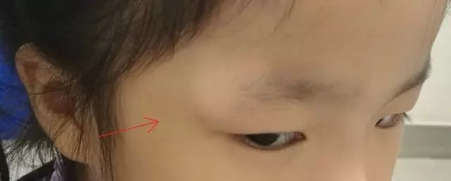 容易误诊为霰粒肿表皮样囊肿虽然非常柔软,但可以造成明显的骨凹陷