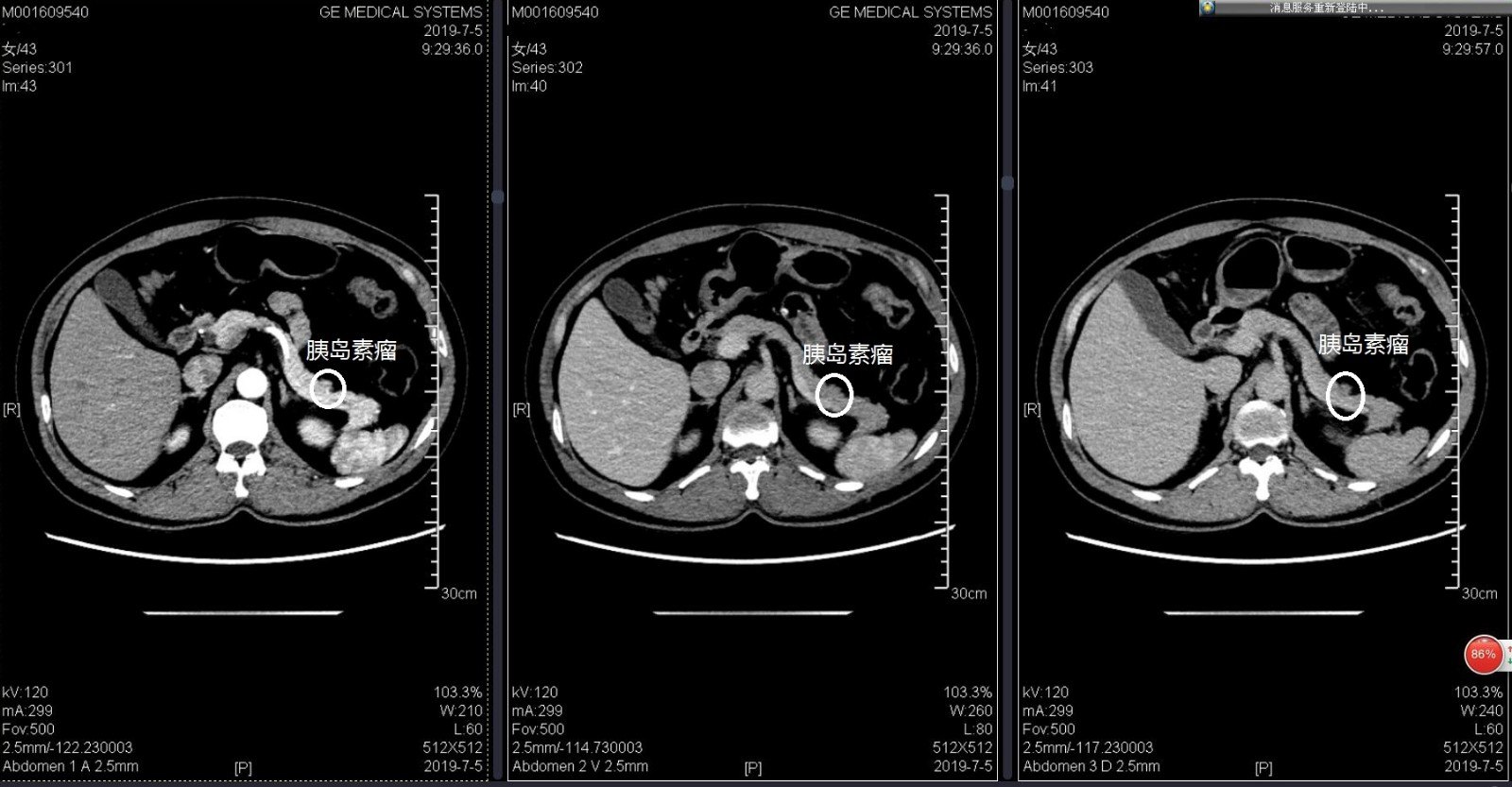 胰岛素瘤是什么病胰腺神经内分泌肿瘤是胰腺癌吗