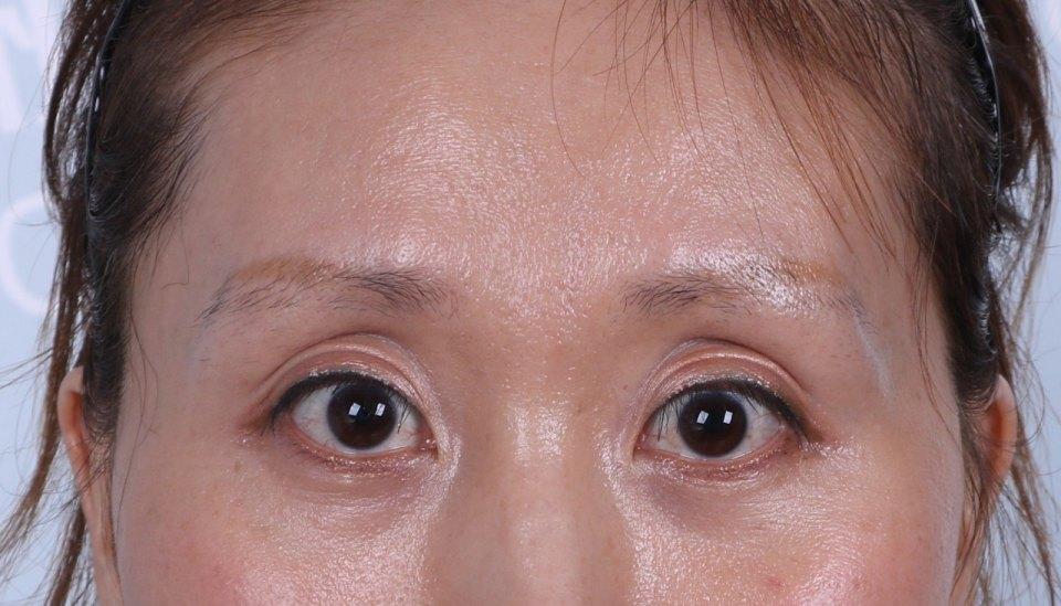 可以在做双眼皮手术时将多余的皮肤去掉一些,然后将眼轮匝肌或者是