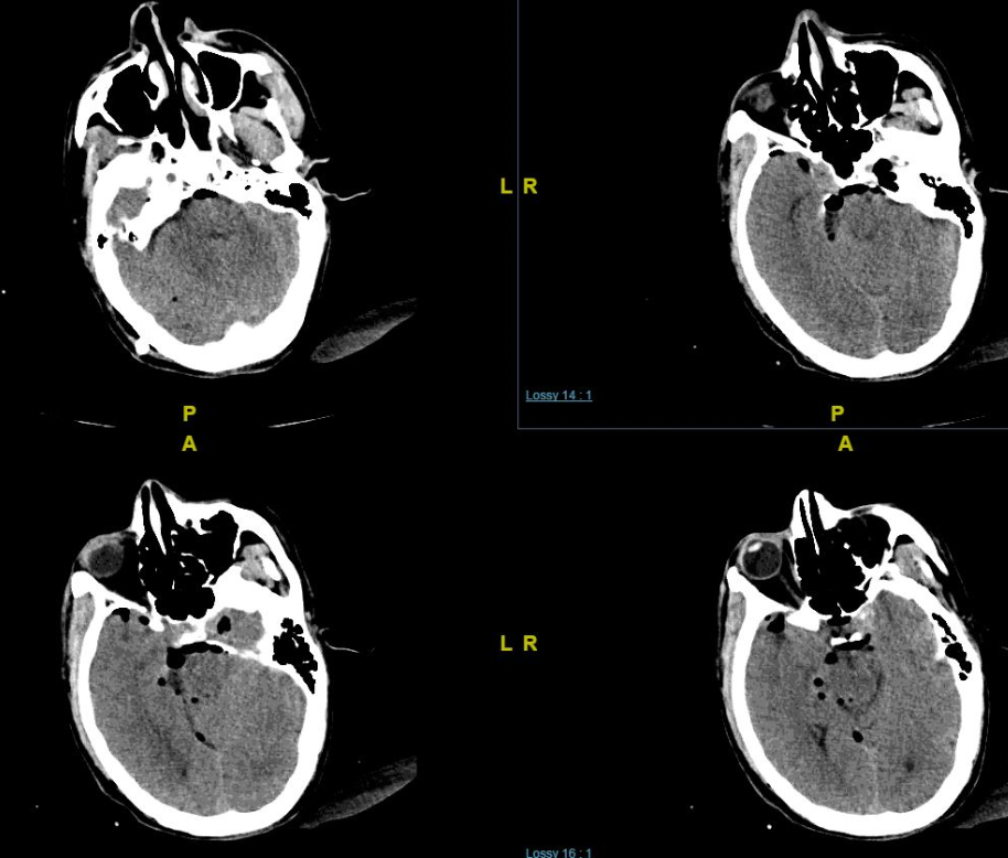 手术切除岩尖脑膜瘤