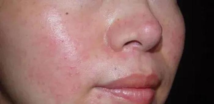 杭城皮肤病医院科普:面部皮炎该怎么区分 - 微医(挂号网)