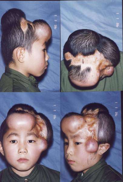 头皮及面部瘢痕的扩张器治疗