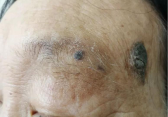 她不到30岁却长了老年斑为什么看这里