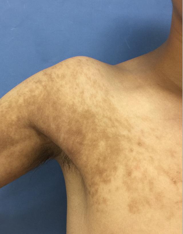 表现为不规则的边界清楚的褐色斑片,"很多人分不清贝克痣与咖啡斑