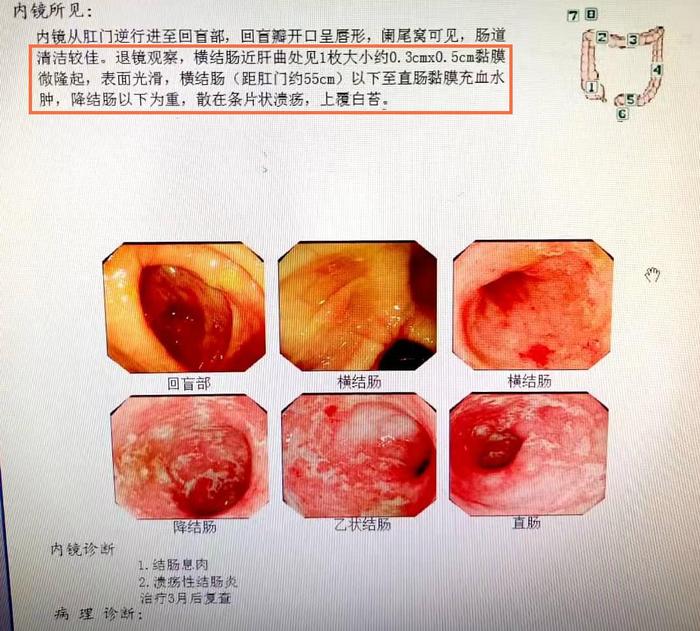 青玉散溃疡性结肠炎